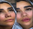 کیلنیک زیبایی مهرزاد - تزریق فیلر لب برای بلاگر عزیزمون رها بها💕