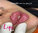 کیلنیک زیبایی مهرزاد - تزریق ژل لب M تکنیک