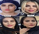 کیلنیک زیبایی مهرزاد - قبل و بعد از جراحی بینی تغییرات و ببینید 😍🤌🏻
