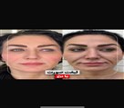 کیلنیک زیبایی مهرزاد - انجام لیفت نخ 