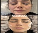کیلنیک زیبایی مهرزاد - انجام لیفت نخ🤌🏻