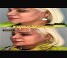 کیلنیک زیبایی مهرزاد - لیفت نخ قسمت سگینگ صورت 