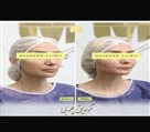 کیلنیک زیبایی مهرزاد - قبل و بعد تزریق چربی🌹