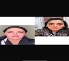 کیلنیک زیبایی مهرزاد - تزریق فیلر برای رفع نواقص صورت 🫢😍