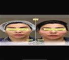 کیلنیک زیبایی مهرزاد - قبل و بعد تزریق چربی🤌🏻