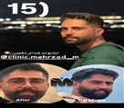 کیلنیک زیبایی مهرزاد - جراحی بینی بعد از ۵ ماه 