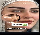 کیلنیک زیبایی مهرزاد - نتیجه کاشت ابرو 💥❤️