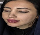 کلینیک زیبایی دکتر رضا مهدوی - تزریق لب با مدل دلخواه شما