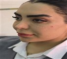 کلینیک زیبایی دکتر رضا مهدوی - بوتاکس چشم گربه ای