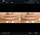 کلینیک پوست زیبایی ونوس (دکتر سیامک یاسمی) - پرولیفت صورت و گردن