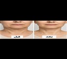 کلینیک پوست زیبایی ونوس (دکتر سیامک یاسمی) - پرولیفت صورت و گردن