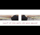 کلینیک پوست زیبایی ونوس (دکتر سیامک یاسمی) - لیفت بازو با پرولیفت قوی