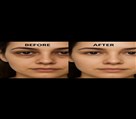 کلینیک پوست زیبایی ونوس (دکتر سیامک یاسمی) - تیرگی و چروک زیر چشم