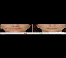 کلینیک پوست زیبایی ونوس (دکتر سیامک یاسمی) - چین و چروک دور دهان و لبها