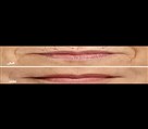 کلینیک پوست زیبایی ونوس (دکتر سیامک یاسمی) - چین و چروک دور دهان و لبها