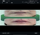 کلینیک پوست زیبایی ونوس (دکتر سیامک یاسمی) - چین و چروک دور دهان و لبها