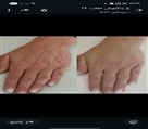 کلینیک پوست زیبایی ونوس (دکتر سیامک یاسمی) - چین و چروک پشت دست 