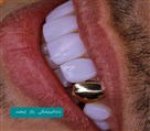 مجتمع دندانپزشکی راز لبخند - لمینیت طلا