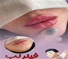 مطب پوست ، مو و زیبایی لمیس - فیلر لب