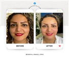کلینیک زیبایی ماهرو - قبل و بعد