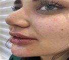 کلینیک زیبایی ماهرو - قبل و بعد