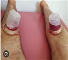 خدمات طب سنتی مجتمع درمانی میثم - حجامت ساقین برای پاکسازی و رفع فشار خون و رفع پادردو گزگزو داغی پا