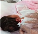 خدمات طب سنتی مجتمع درمانی میثم - حجامت زردی نوزاد