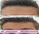 کلینیک زیبایی زرین - بوتاکس نچرال