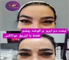کلینیک زیبایی زرین - لیفت ابرو