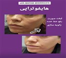 کلینیک زیبایی زرین - جوانسازی با هایفو
