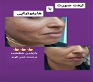 کلینیک زیبایی زرین - جوانسازی با هایفو