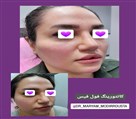 کلینیک زیبایی زرین - کانتور صورت