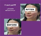 کلینیک زیبایی زرین - کانتورصورت