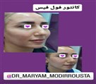 کلینیک زیبایی زرین - کانتور صورت