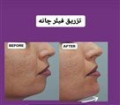 کلینیک زیبایی زرین - فرم دهی چانه