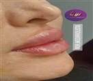 کلینیک زیبایی زرین - فیلرلب روسی