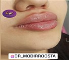 کلینیک زیبایی زرین - ژل لب قلبی شکل