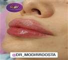 کلینیک زیبایی زرین - فیلرلب ترند امسال