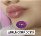 کلینیک زیبایی زرین - ژل لب دخترونه