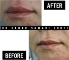 کلینیک پوست و زیبایی مهربان - فیلر لب 