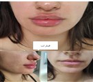 کلینیک پوست و زیبایی مهربان - فیلر لب
