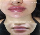 کلینیک پوست و زیبایی مهربان - فیلر لب