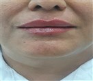 کلینیک پوست و زیبایی مهربان - فیلر لب طبیعی