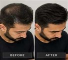 پروتز مو و ترمیم موی هیرپروتز - تصویر 144999